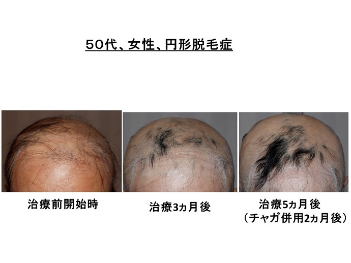 円形脱毛症　病院